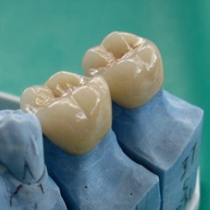 Porcelain Crowns Jackson TN